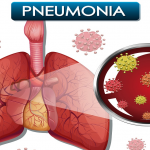 pneumonia