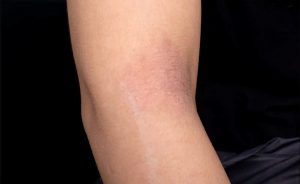 Lima Penyebab Stretch Mark, Bisa Picu Depresi