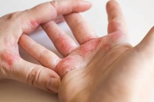 Percepat Eliminasi Kusta dan Filariasis, Kemenkes Target Bebas NTDs pada 2030