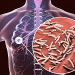 Tuberkulosis (TB). (Ilustrasi: AI Care)