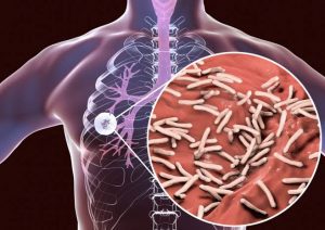 Bersatu Mengakhiri Epidemi Tuberkulosis