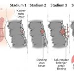 kanker usus