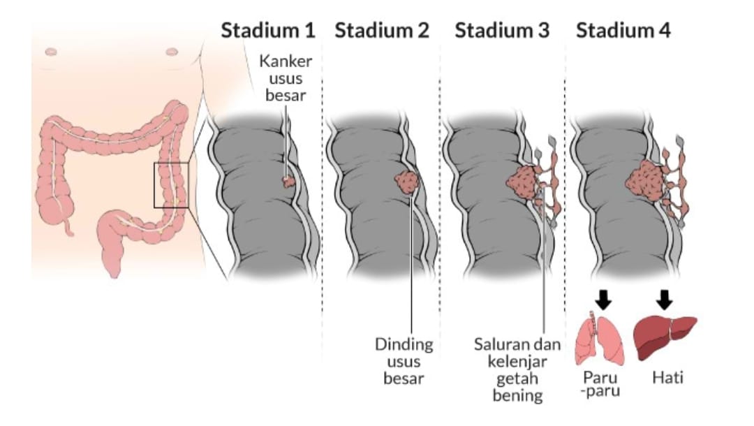 Waspadai Kanker Usus Besar: Pembunuh Diam-diam yang Banyak Menyerang Perempuan, Apa Saja Gejalanya?