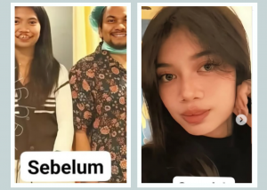 Rista Junianti Viral Makin Bersinar Setelah Operasi Bibir Sumbing di dr Tompi