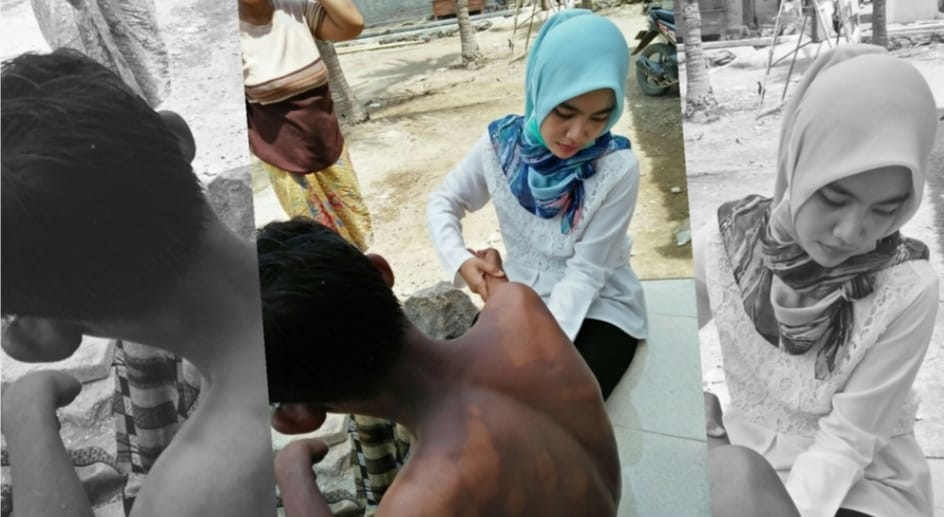 Indonesia Peringkat 3 Kasus Kusta di Dunia, Menkes Ingatkan: Terlambat Diperiksa, Risiko Disabilitas Meningkat