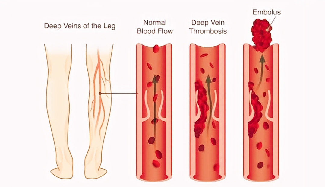 Pembekuan Darah di Kaki Jangan Dianggap Sepele, Ini Gejalanya